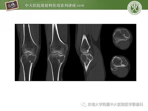 骨肿瘤及类肿瘤病变的影像诊断思路 