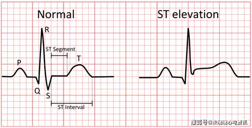 心电图st异常注意什么