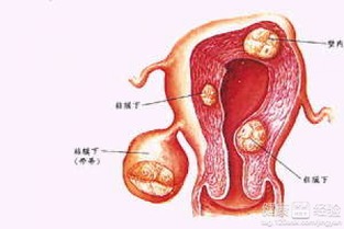 子宫小肌瘤有哪些症状