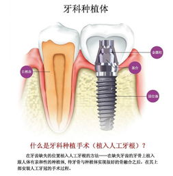 抽烟对种植牙有没有影响 