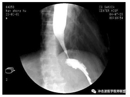 胶囊内镜 CT 钡餐可以取代普通胃肠镜检查吗