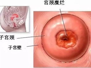 宫颈糜烂怎么造成的原因(宫颈糜烂是怎么引起的)