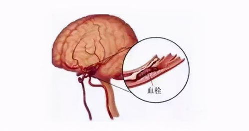 脑血栓的诱因有哪些