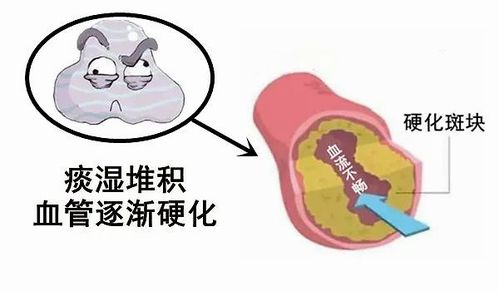大白话说中医第一百二十五期 运动促进降血脂,环境辅助化痰湿