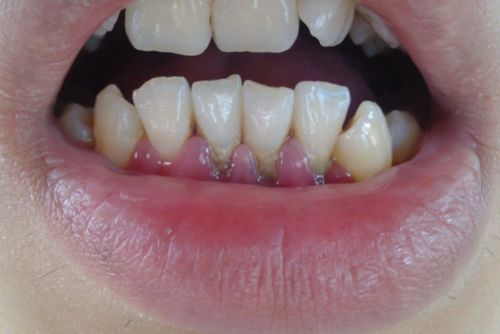 儿童牙齿变黑是什么原因 