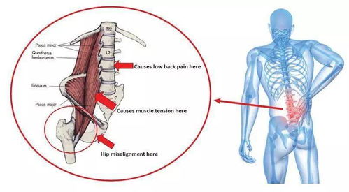伸展和拉伸紧绷的腰大肌未必总是件对的
