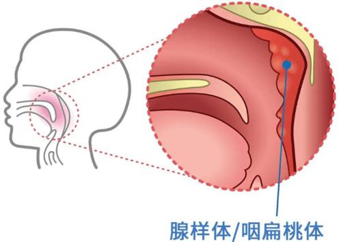 儿童腺样体肥大,各位宝妈们是手术切除还是保守治疗呢