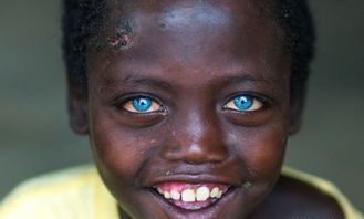 8岁黑人男孩却拥有蓝色眼睛,父母知道原因后,很是悲伤