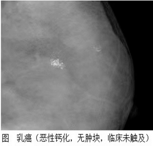 乳腺检查,选超声还是钼靶