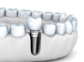 做种植牙都有哪些材料