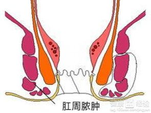 肛周脓肿发作的明显症状有哪些