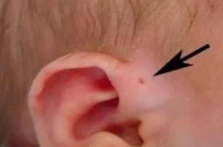 孩子耳朵有这种 孔 ,家长一定要留意,别傻傻以为是好事