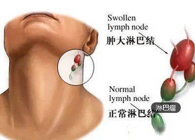 淋巴结肿大 疼,反而是件好事 这是怎么回事