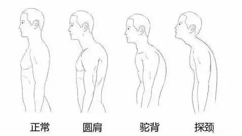 家长总提醒你 把背挺直了 ,难看的 头前伸 该怎么纠正