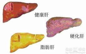 患有脂肪肝的患者能吃冰糖吗