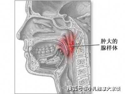 李波 孩子腺样体肥大需要做手术切除 可以试试小儿推拿的方法