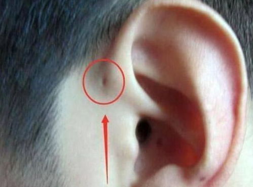 为啥有些孩子耳朵有 小孔 和命运没关系,医生告诫不能大意