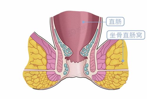 肛门脱出 小肉球 ,尴尬又无言 记住这3招,带你远离脱肛