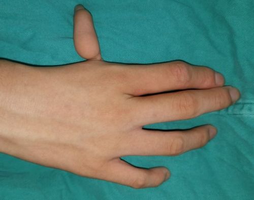 大拇指漂浮拇没有功能,会导致孩子的食指和中指变形