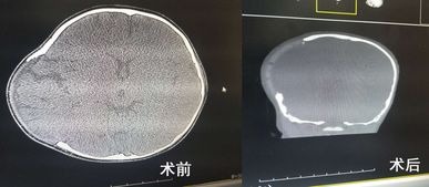 低龄童,脑膨出,碎骨屑,航空总医院这颅骨修补难度不小