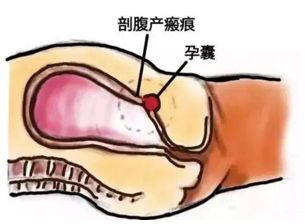 剖腹产多久可以生二胎 这应该是很多宝爸宝妈想知道的