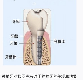 种植牙过程 
