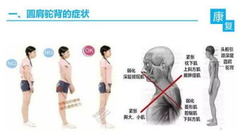 驼背圆肩的人如何通过日常中简单的锻炼得到矫正(圆驼背肩健身改善)