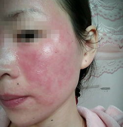 皮肤过敏一直反复发作要怎么办 在广州哪里看皮肤过敏好 