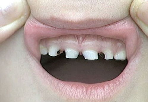 换牙期孩子得龋齿,有没有必要去补牙 看看牙科医生怎么说