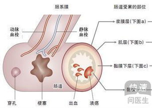 肠梗阻保守治疗的方法 保守治疗效果好