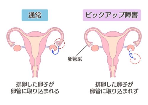 JMT日本医疗 一文解析不孕症男女双方的主要原因和检查方法分别是什么
