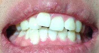 长期用一边牙齿咀嚼食物会导致怎样的后果