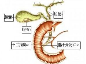 专家介绍胆囊结石要怎么预防 