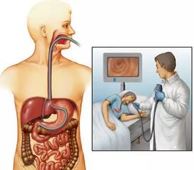 做胃镜到底有什么风险 需要多久做一次