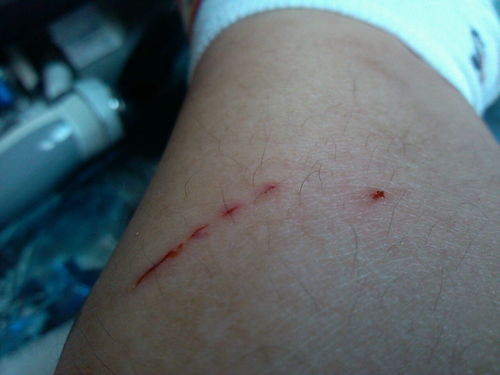 请问我腿上的伤口是被外婆家的老猫抓了,但是我没确定小红色伤口是不是猫咬的,当时用了酒精消毒 