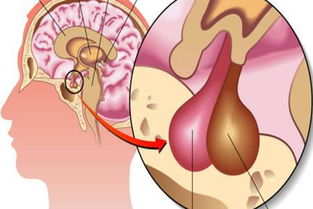 腦垂體瘤能治好嗎，垂體瘤手術(shù)器械招標(biāo)