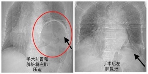 宁乡市人民医院普外科接连开展多例高难度手术,凭实力 圈粉