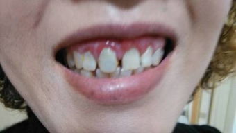 牙有问题吗 有时候牙龈会肿,且太难看了,能从牙龈里挤出脓一样的白色的东西 