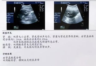 肾病最重要的3项检查,一个都不能少