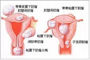 如果一个女人没了子宫会怎样 你绝对想像不到 