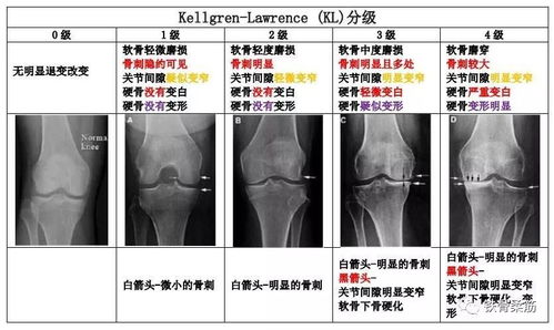 膝关节炎注射玻璃酸钠效果如何 到底该不该用