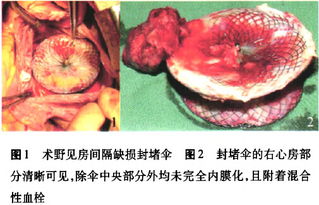 房间隔缺损封堵术后3年附着血栓取出术1例 