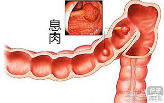 肠息肉必须动手术吗