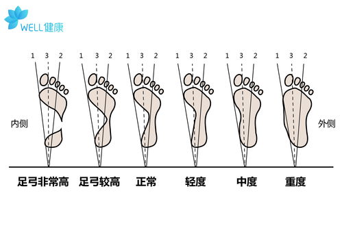 脚后跟疼痛,或是高足弓惹的祸 