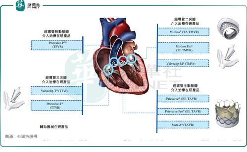 心通医疗-B(02160)：自主研发经导管二尖瓣置换系统在多例人体植入中表现出色