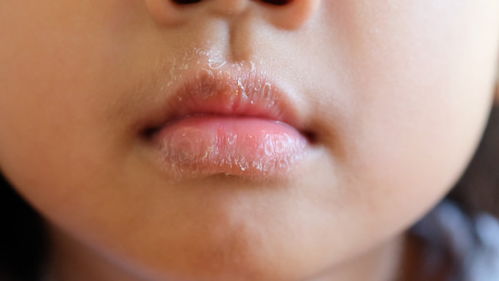 唇炎的危害,详解唇炎的3大危害和2个饮食禁忌