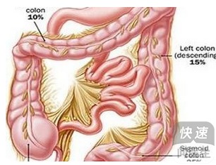 结肠息肉切除后症状 术后护理要注意的问题