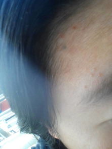 谁帮我看看我额头上的有点发青黑点的是什么,长了好久了,会不会是皮肤癌什么的 会不会扩散呢 