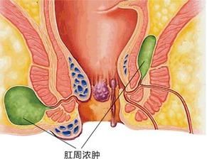 肛周脓肿手术之后要注意什么 