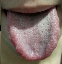 舌苔白厚图片及症状图片